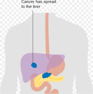 Illustration Pancreatic Cancer Hd Png Download